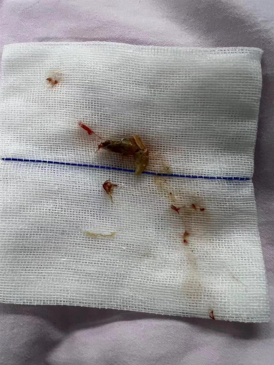 doctor removes shrimp from woman's air tube, using low-invasive process