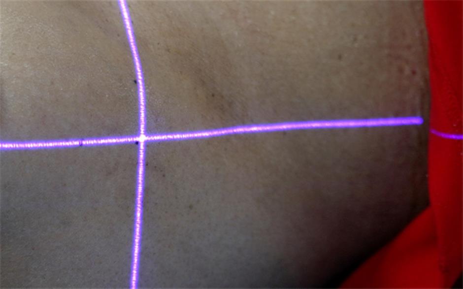 dots mark the spot: tattoo guides radiotherapy, benefiting patients